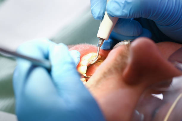 Best Emergency Wisdom Teeth Removal in Russellville, KY